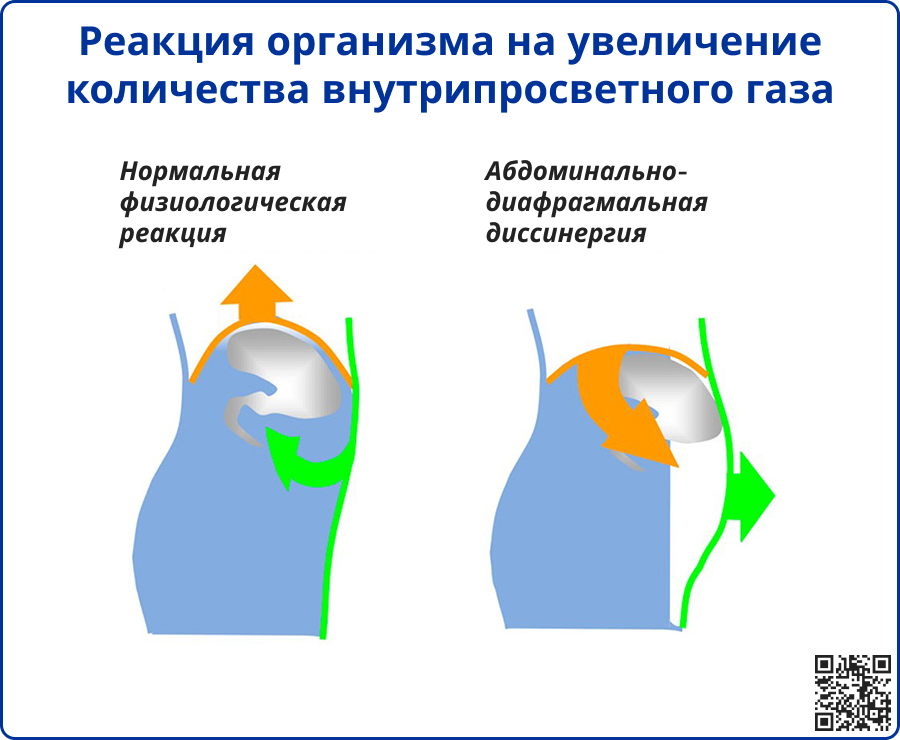 Абдоминальная диссинергия